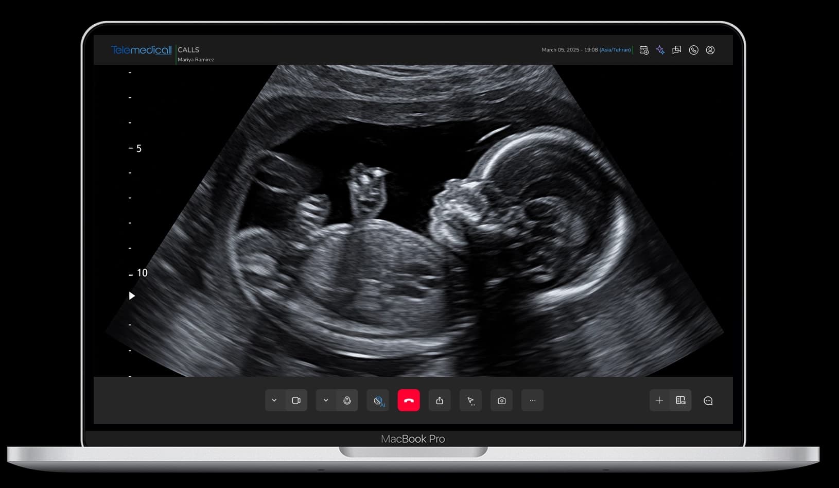 Ultrasound sonography via Telemedicall